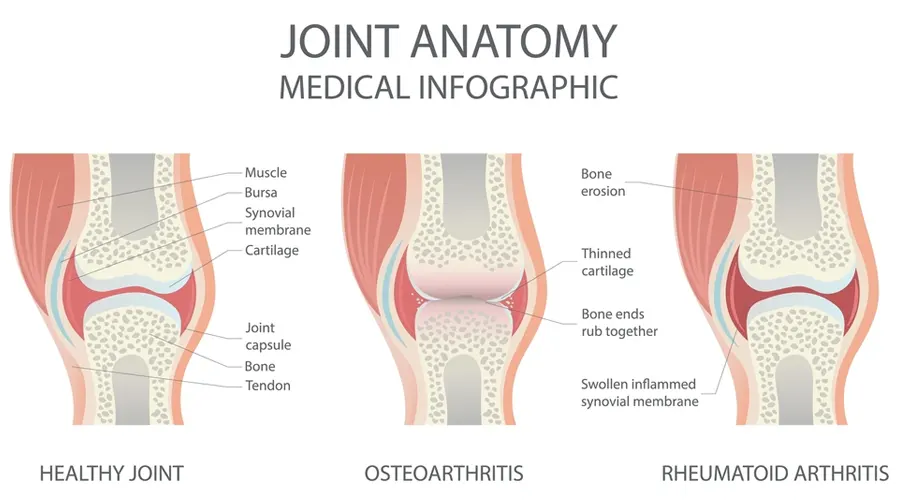 Common Joint Problems